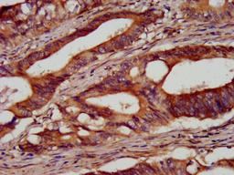 IHC image of CSB-PA866208LA01HU diluted at 1:100 and staining in paraffin-embedded human colon cancer performed on a Leica BondTM system. After dewaxing and hydration, antigen retrieval was mediated by high pressure in a citrate buffer (pH 6.0). Section was blocked with 10% normal goat serum 30min at RT. Then primary antibody (1% BSA) was incubated at 4&deg;C overnight. The primary is detected by a biotinylated secondary antibody and visualized using an HRP conjugated SP system.