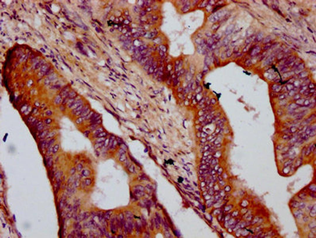 IHC image of CSB-PA752530LA01HU diluted at 1:400 and staining in paraffin-embedded human colon cancer performed on a Leica BondTM system. After dewaxing and hydration, antigen retrieval was mediated by high pressure in a citrate buffer (pH 6.0). Section was blocked with 10% normal goat serum 30min at RT. Then primary antibody (1% BSA) was incubated at 4&deg;C overnight. The primary is detected by a biotinylated secondary antibody and visualized using an HRP conjugated SP system.
