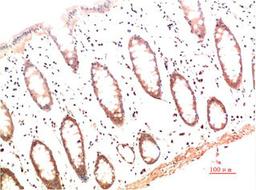 Immunohistochemical analysis of paraffin-embedded Human Colon Carcinoma Tissue using Collagen I  Mouse mAb diluted at 1:200.