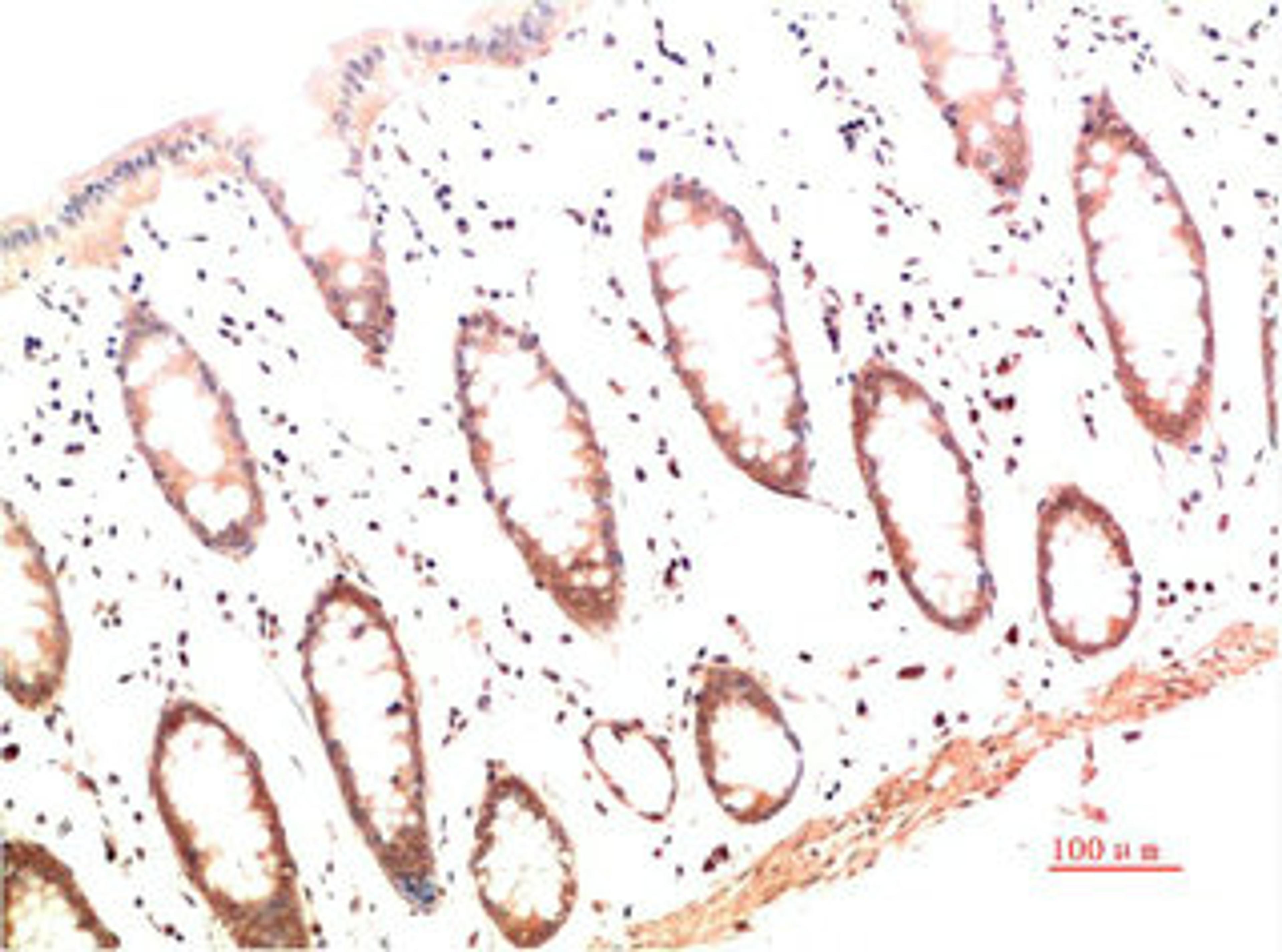 Immunohistochemical analysis of paraffin-embedded Human Colon Carcinoma Tissue using Collagen I  Mouse mAb diluted at 1:200.