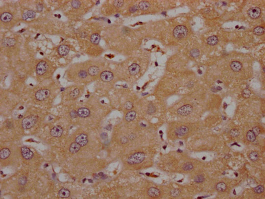 IHC image of CSB-PA836757OA01HU diluted at 1:200 and staining in paraffin-embedded human liver cancer performed on a Leica BondTM system. After dewaxing and hydration, antigen retrieval was mediated by high pressure in a citrate buffer (pH 6.0). Section was blocked with 10% normal goat serum 30min at RT. Then primary antibody (1% BSA) was incubated at 4°C overnight. The primary is detected by a Goat anti-rabbit polymer IgG labeled by HRP and visualized using 0.05% DAB.