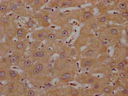 IHC image of CSB-PA836757OA01HU diluted at 1:200 and staining in paraffin-embedded human liver cancer performed on a Leica BondTM system. After dewaxing and hydration, antigen retrieval was mediated by high pressure in a citrate buffer (pH 6.0). Section was blocked with 10% normal goat serum 30min at RT. Then primary antibody (1% BSA) was incubated at 4°C overnight. The primary is detected by a Goat anti-rabbit polymer IgG labeled by HRP and visualized using 0.05% DAB.