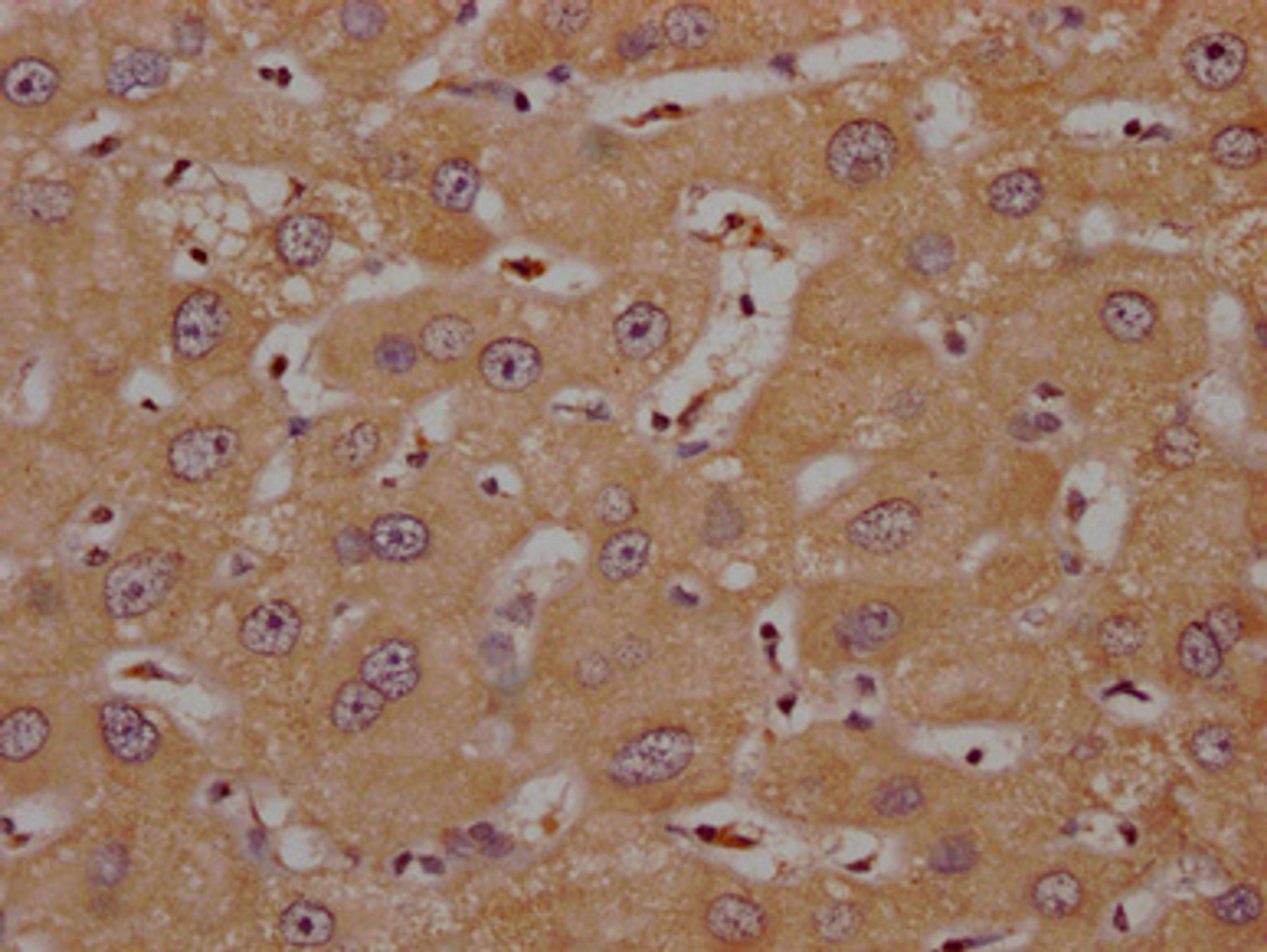 IHC image of CSB-PA836757OA01HU diluted at 1:200 and staining in paraffin-embedded human liver cancer performed on a Leica BondTM system. After dewaxing and hydration, antigen retrieval was mediated by high pressure in a citrate buffer (pH 6.0). Section was blocked with 10% normal goat serum 30min at RT. Then primary antibody (1% BSA) was incubated at 4°C overnight. The primary is detected by a Goat anti-rabbit polymer IgG labeled by HRP and visualized using 0.05% DAB.