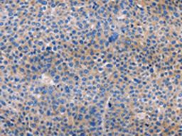 The image on the left is immunohistochemistry of paraffin-embedded Human liver cancer tissue using CSB-PA248410(AMACR Antibody) at dilution 1/30, on the right is treated with fusion protein. (Original magnification: ×200)