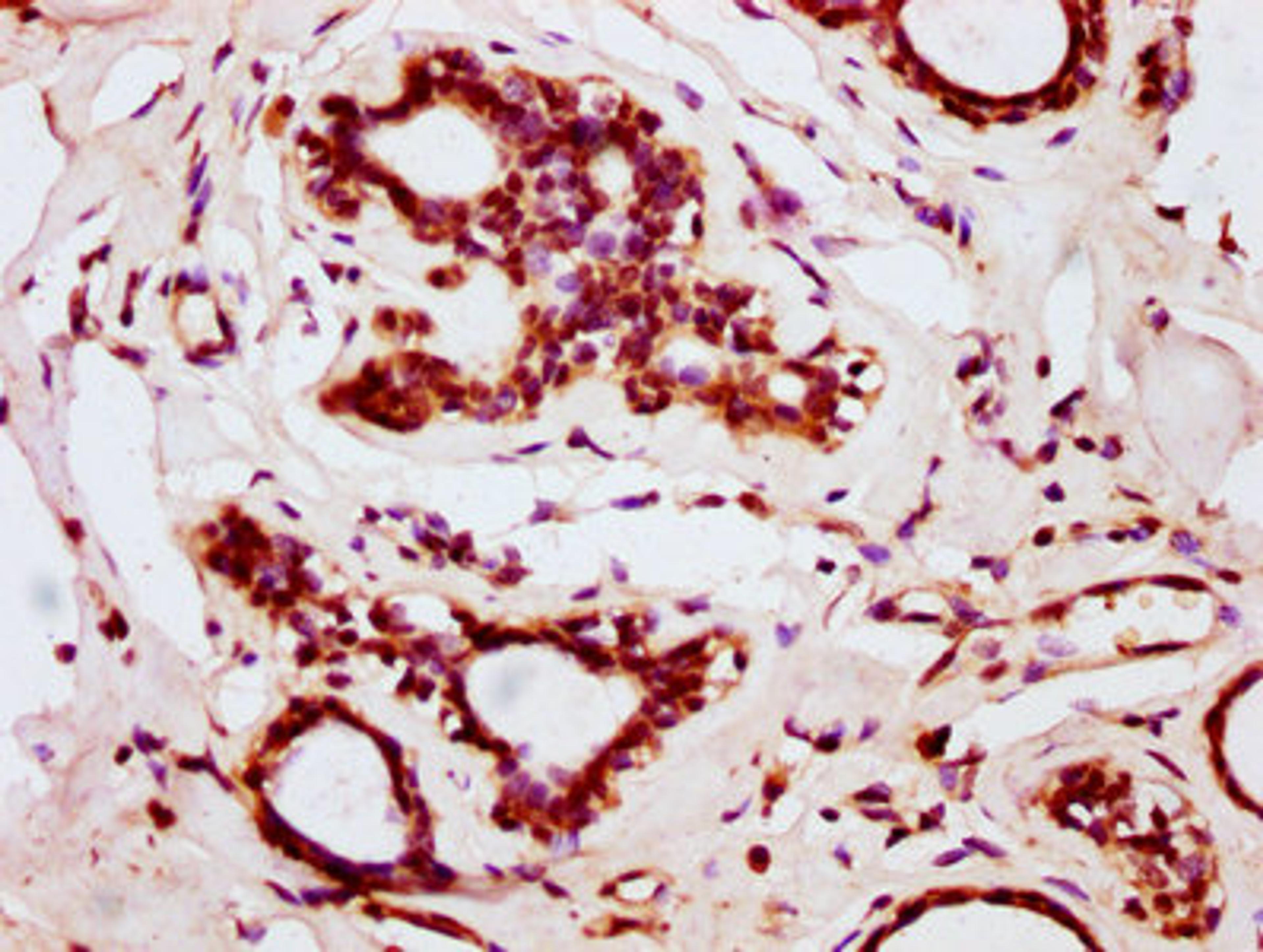 IHC image of CSB-PA867143LA01HU diluted at 1:200 and staining in paraffin-embedded human breast cancer performed on a Leica BondTM system. After dewaxing and hydration, antigen retrieval was mediated by high pressure in a citrate buffer (pH 6.0). Section was blocked with 10% normal goat serum 30min at RT. Then primary antibody (1% BSA) was incubated at 4&deg;C overnight. The primary is detected by a biotinylated secondary antibody and visualized using an HRP conjugated SP system.