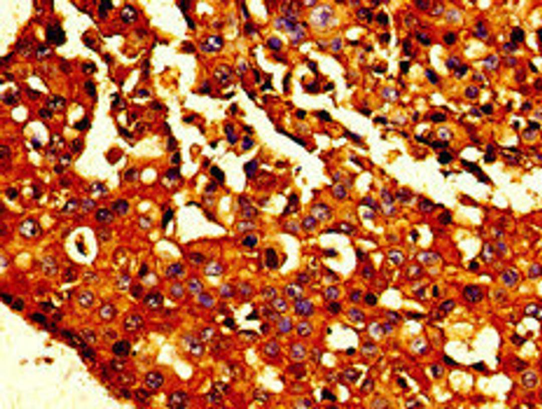 Immunohistochemistry of paraffin-embedded human breast cancer using CSB-PA06239A0Rb at dilution of 1:100