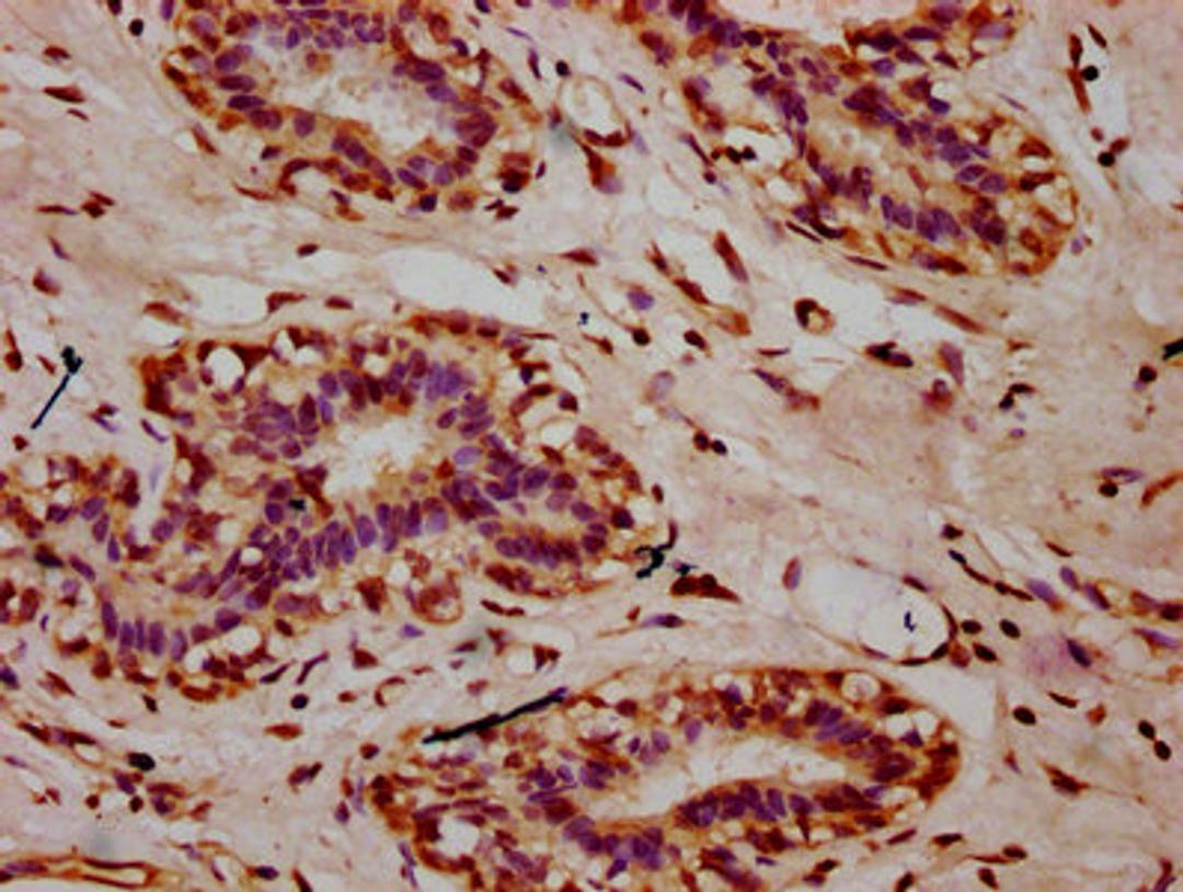 IHC image of CSB-PA010389OA09nacHU diluted at 1:10 and staining in paraffin-embedded human breast cancer performed on a Leica BondTM system. After dewaxing and hydration, antigen retrieval was mediated by high pressure in a citrate buffer (pH 6.0). Section was blocked with 10% normal goat serum 30min at RT. Then primary antibody (1% BSA) was incubated at 4&deg;C overnight. The primary is detected by a biotinylated secondary antibody and visualized using an HRP conjugated SP system.