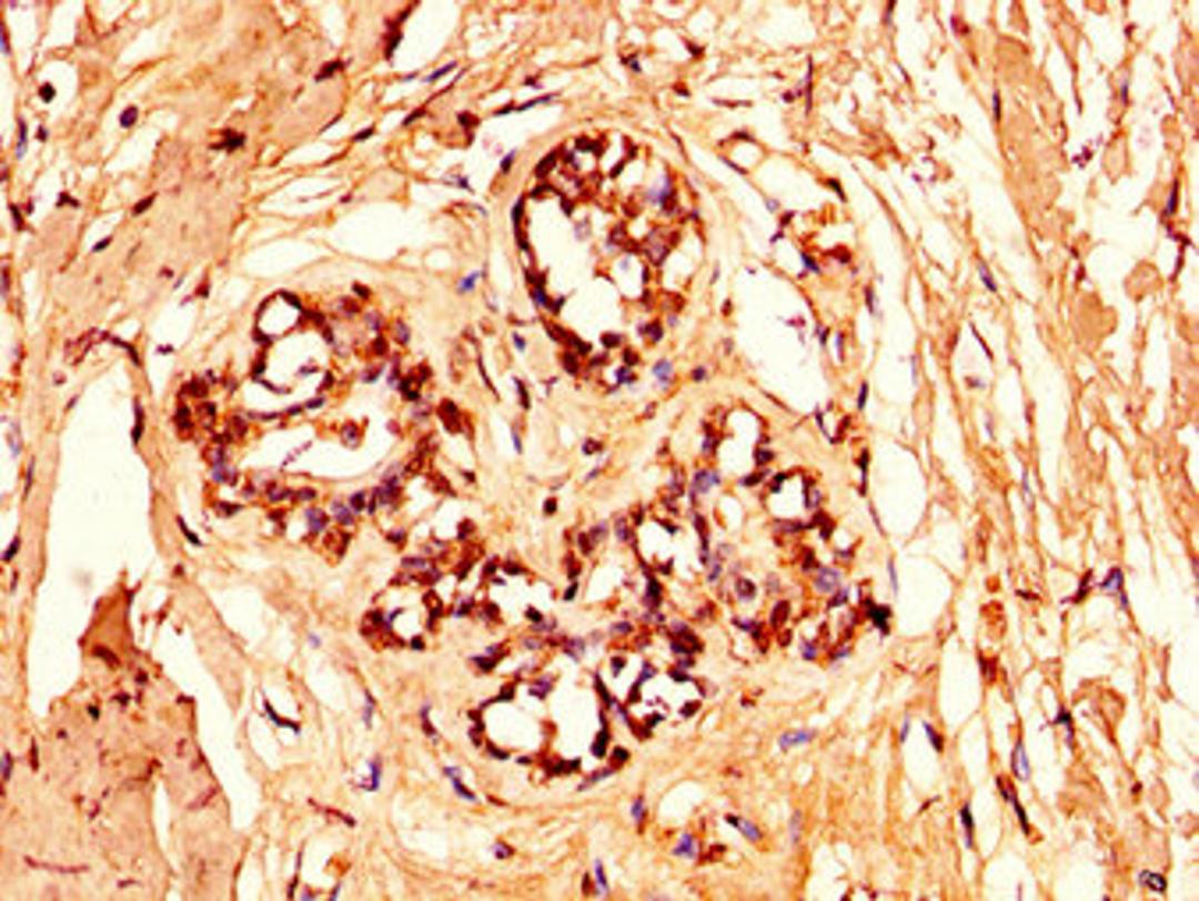 IHC image of CSB-PA010378OA96nforHU diluted at 1:50 and staining in paraffin-embedded human breast cancer performed on a Leica BondTM system. After dewaxing and hydration, antigen retrieval was mediated by high pressure in a citrate buffer (pH 6.0). Section was blocked with 10% normal goat serum 30min at RT. Then primary antibody (1% BSA) was incubated at 4&deg;C overnight. The primary is detected by a biotinylated secondary antibody and visualized using an HRP conjugated SP system.