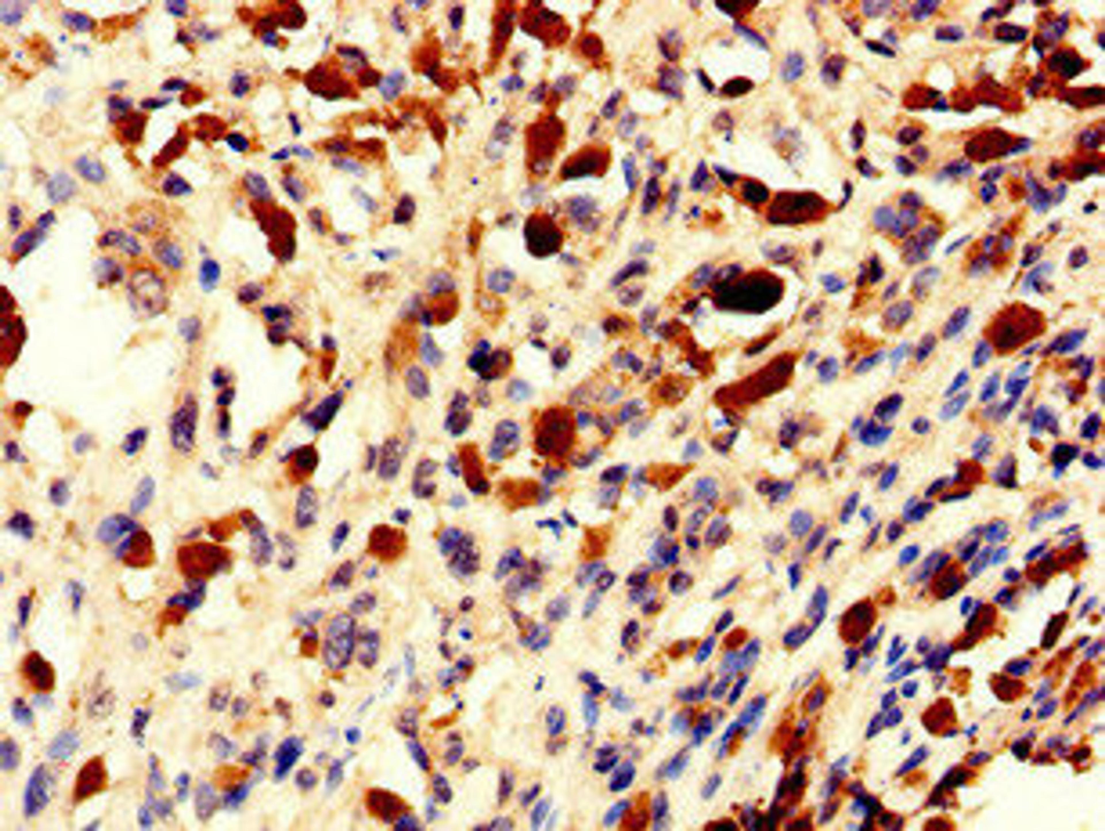 Immunohistochemistry of paraffin-embedded human melanoma using CSB-PA873677LA01HU at dilution of 1:100