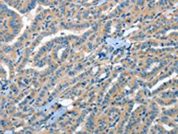 The image on the left is immunohistochemistry of paraffin-embedded Human thyroid cancer tissue using CSB-PA827156(RAP1A Antibody) at dilution 1/35, on the right is treated with fusion protein. (Original magnification: ×200)