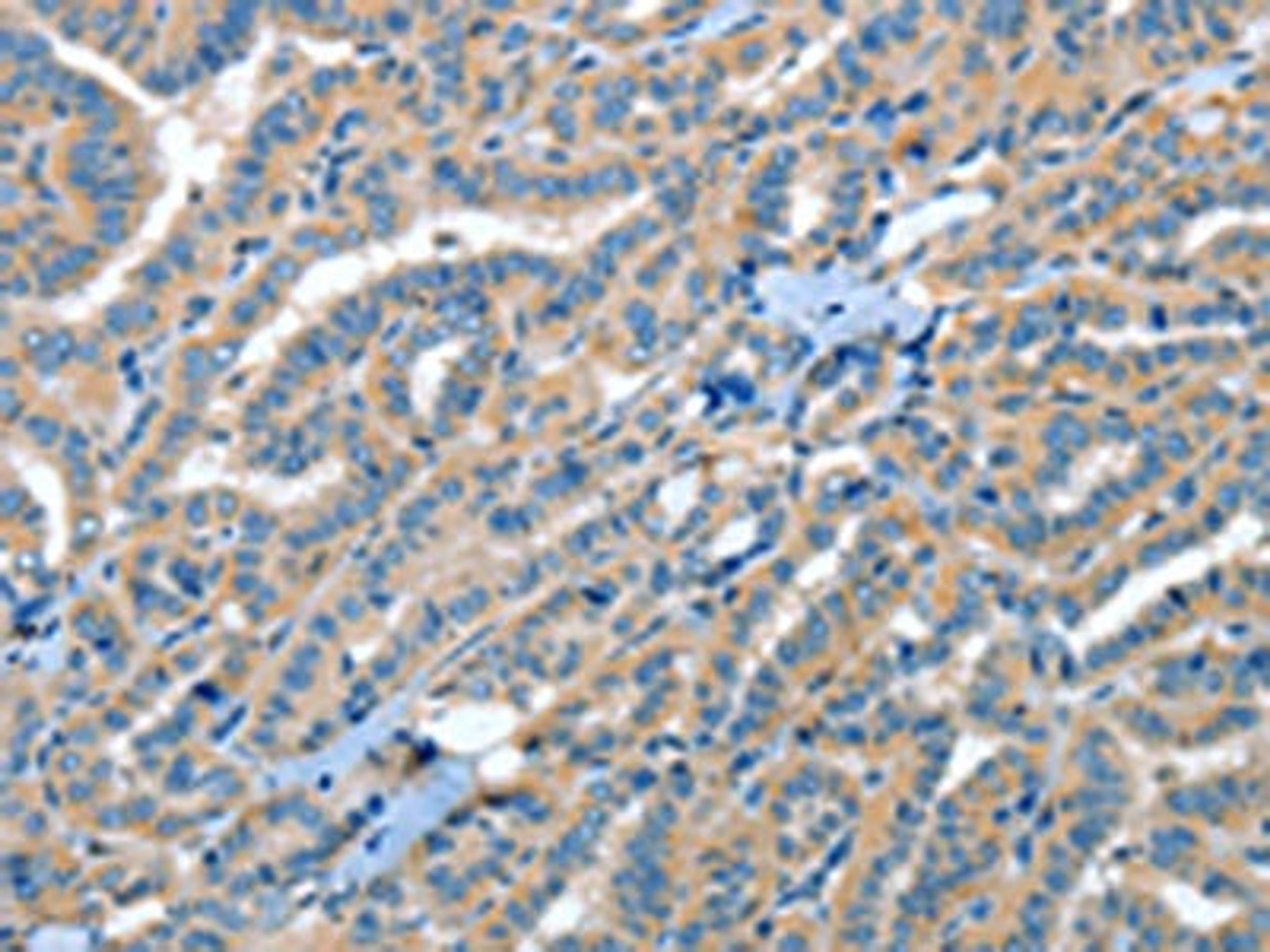 The image on the left is immunohistochemistry of paraffin-embedded Human thyroid cancer tissue using CSB-PA827156(RAP1A Antibody) at dilution 1/35, on the right is treated with fusion protein. (Original magnification: ×200)