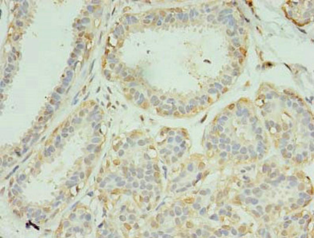 Immunohistochemistry of paraffin-embedded human breast cancer using CSB-PA856883LA01HU at dilution of 1:100