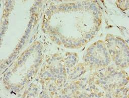 Immunohistochemistry of paraffin-embedded human breast cancer using CSB-PA856883LA01HU at dilution of 1:100