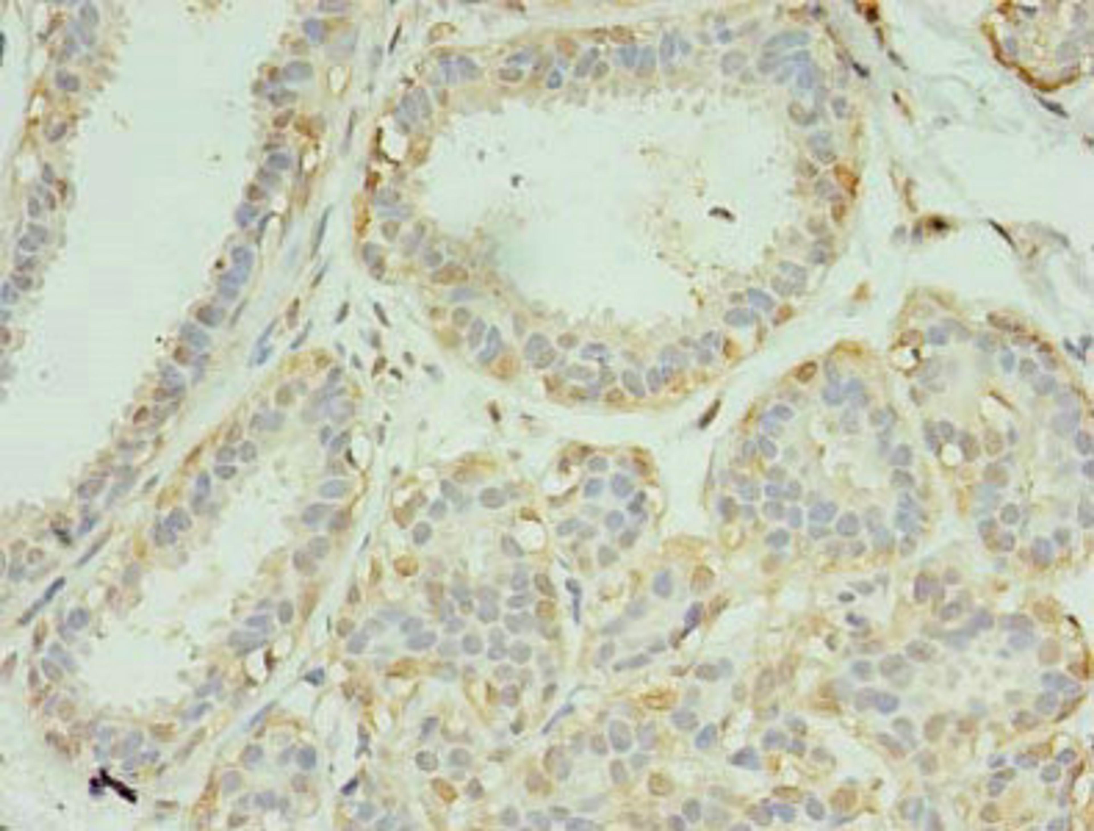 Immunohistochemistry of paraffin-embedded human breast cancer using CSB-PA856883LA01HU at dilution of 1:100