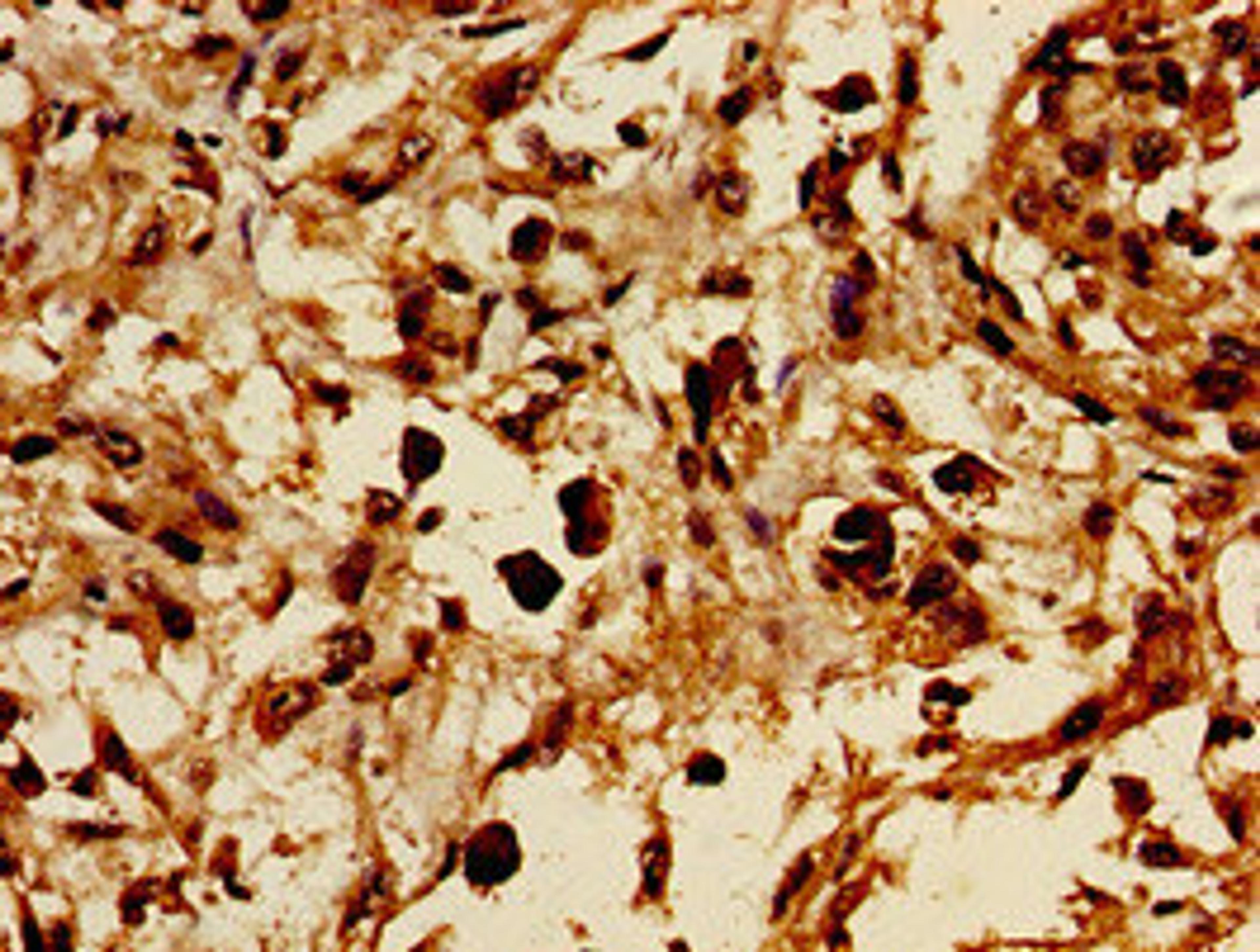 Immunohistochemistry of paraffin-embedded human melanoma using CSB-PA009887LA01HU at dilution of 1:100