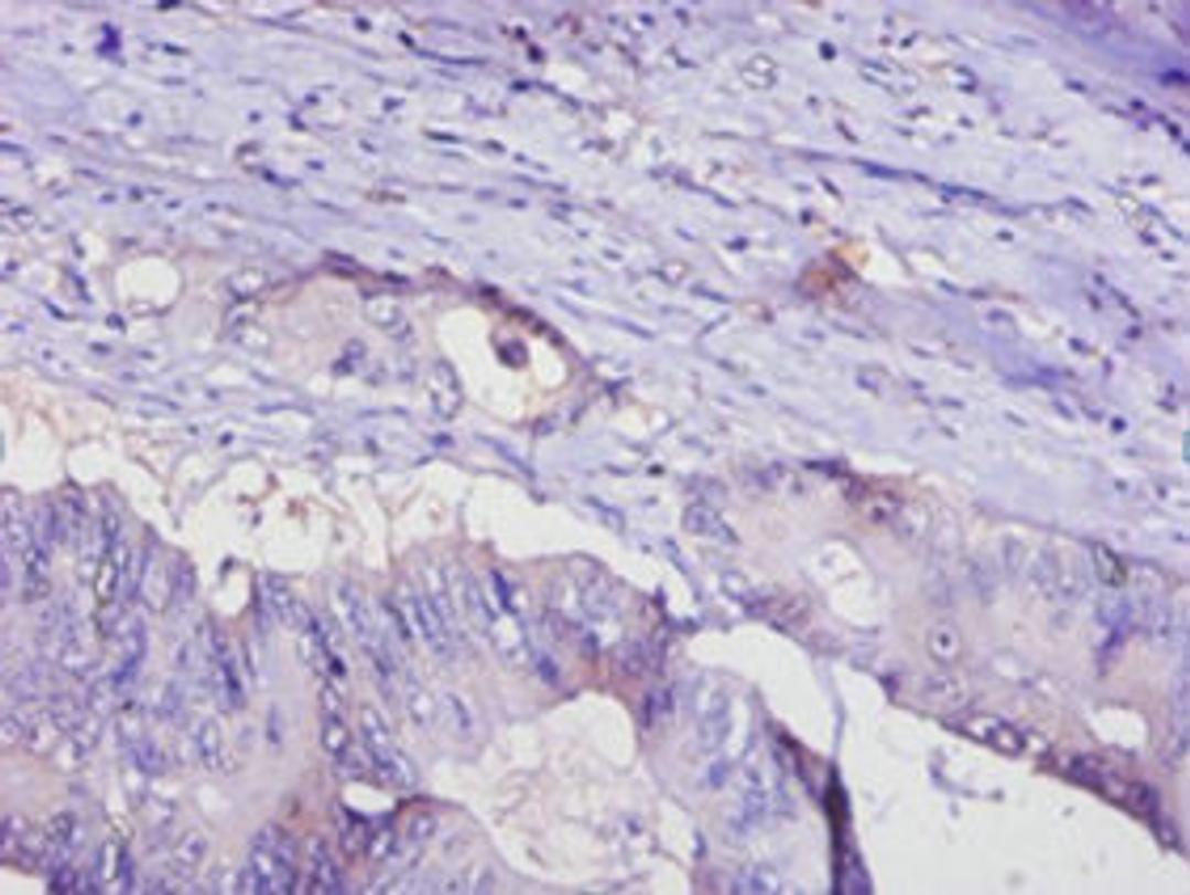 Immunohistochemistry of paraffin-embedded human colon cancer using CSB-PA07956A0Rb at dilution of 1:100
