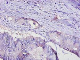 Immunohistochemistry of paraffin-embedded human colon cancer using CSB-PA07956A0Rb at dilution of 1:100