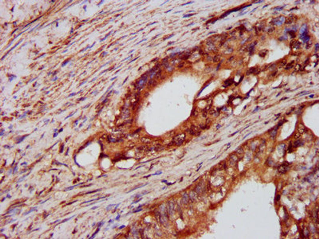 IHC image of CSB-PA019040LA01HU diluted at 1:600 and staining in paraffin-embedded human colon cancer performed on a Leica BondTM system. After dewaxing and hydration, antigen retrieval was mediated by high pressure in a citrate buffer (pH 6.0). Section was blocked with 10% normal goat serum 30min at RT. Then primary antibody (1% BSA) was incubated at 4&deg;C overnight. The primary is detected by a biotinylated secondary antibody and visualized using an HRP conjugated SP system.
