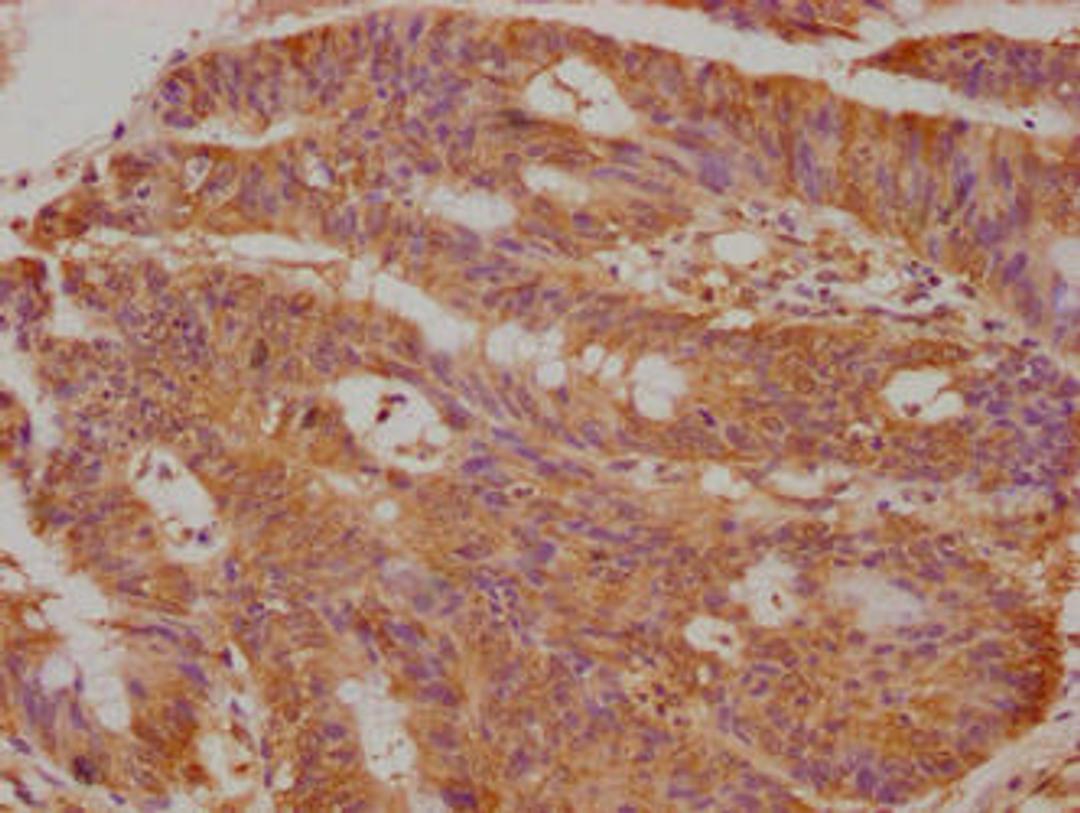 Immunohistochemical of paraffin-embedded human colon cancer using CSB-MA0234331A0m at dilution of 1:50
