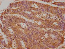 Immunohistochemical of paraffin-embedded human colon cancer using CSB-MA0234331A0m at dilution of 1:50