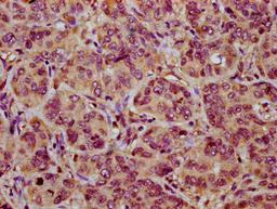IHC image of CSB-PA015964LA01HU diluted at 1:200 and staining in paraffin-embedded human liver cancer performed on a Leica BondTM system. After dewaxing and hydration, antigen retrieval was mediated by high pressure in a citrate buffer (pH 6.0). Section was blocked with 10% normal goat serum 30min at RT. Then primary antibody (1% BSA) was incubated at 4&deg;C overnight. The primary is detected by a biotinylated secondary antibody and visualized using an HRP conjugated SP system.