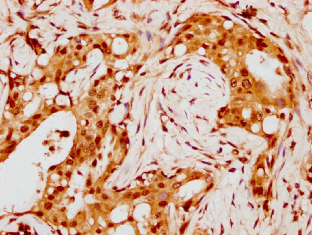 IHC image of CSB-PA010429PA88nohHU diluted at 1:8 and staining in paraffin-embedded human breast cancer performed on a Leica BondTM system. After dewaxing and hydration, antigen retrieval was mediated by high pressure in a citrate buffer (pH 6.0). Section was blocked with 10% normal goat serum 30min at RT. Then primary antibody (1% BSA) was incubated at 4°C overnight. The primary is detected by a biotinylated secondary antibody and visualized using an HRP conjugated SP system.
