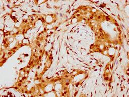 IHC image of CSB-PA010429PA88nohHU diluted at 1:8 and staining in paraffin-embedded human breast cancer performed on a Leica BondTM system. After dewaxing and hydration, antigen retrieval was mediated by high pressure in a citrate buffer (pH 6.0). Section was blocked with 10% normal goat serum 30min at RT. Then primary antibody (1% BSA) was incubated at 4°C overnight. The primary is detected by a biotinylated secondary antibody and visualized using an HRP conjugated SP system.