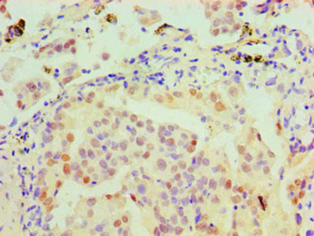 Immunohistochemical of paraffin-embedded Human lung cancer tissue using CSB-MA0150321A0m at dilution of 1:200.