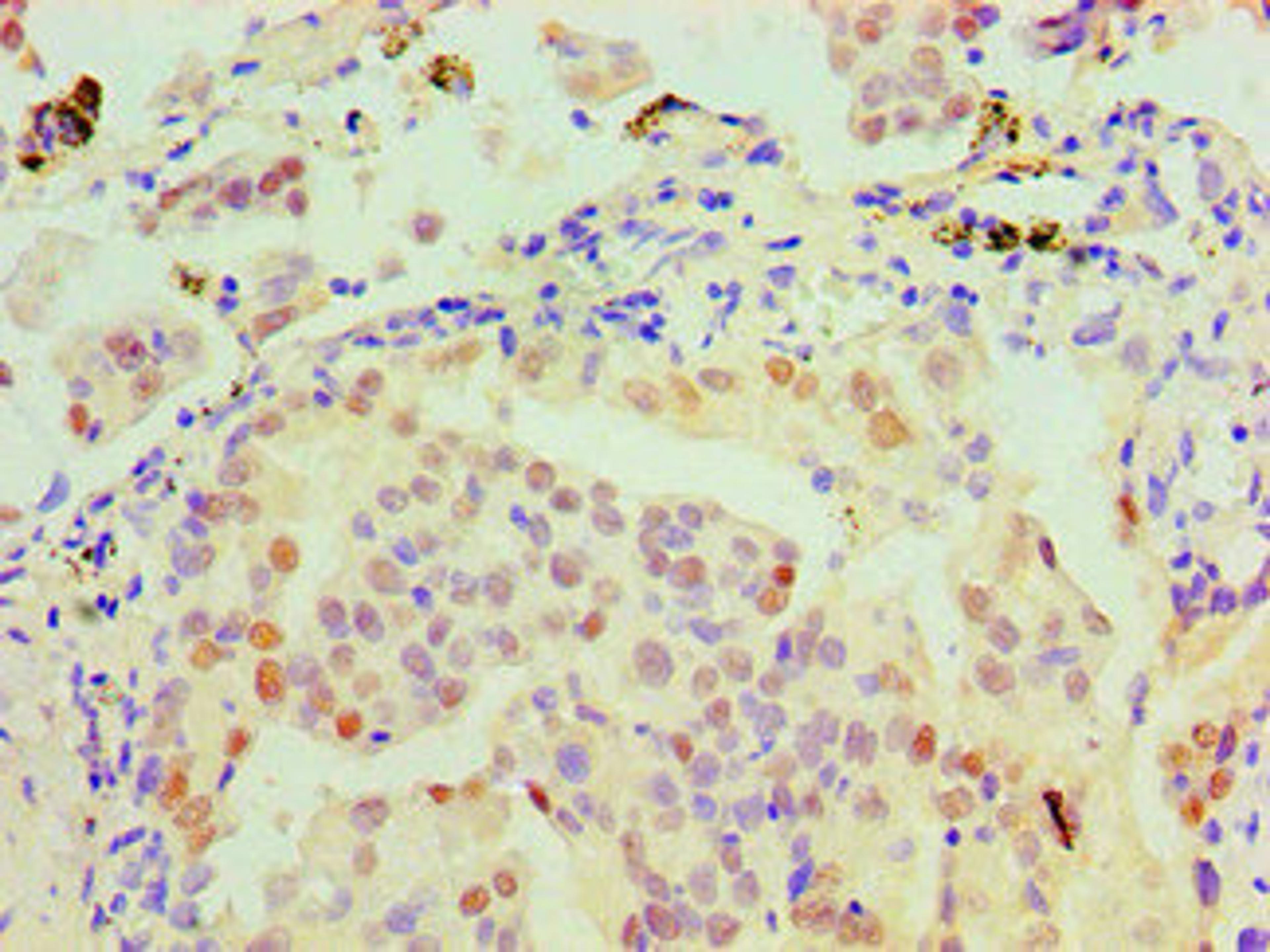 Immunohistochemical of paraffin-embedded Human lung cancer tissue using CSB-MA0150321A0m at dilution of 1:200.