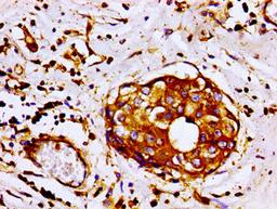 Immunohistochemistry of paraffin-embedded human breast cancer using CSB-PA008724LA01HU at dilution of 1:100