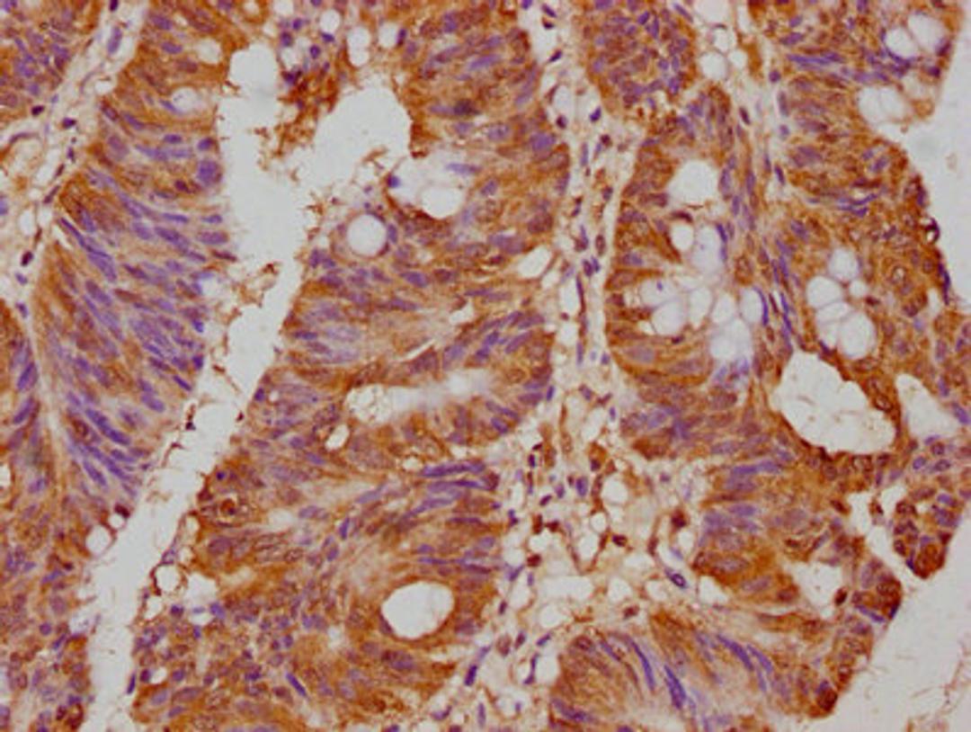 IHC image of CSB-PA017647LA01HU diluted at 1:500 and staining in paraffin-embedded human colon cancer performed on a Leica BondTM system. After dewaxing and hydration, antigen retrieval was mediated by high pressure in a citrate buffer (pH 6.0). Section was blocked with 10% normal goat serum 30min at RT. Then primary antibody (1% BSA) was incubated at 4°C overnight. The primary is detected by a biotinylated secondary antibody and visualized using an HRP conjugated SP system.