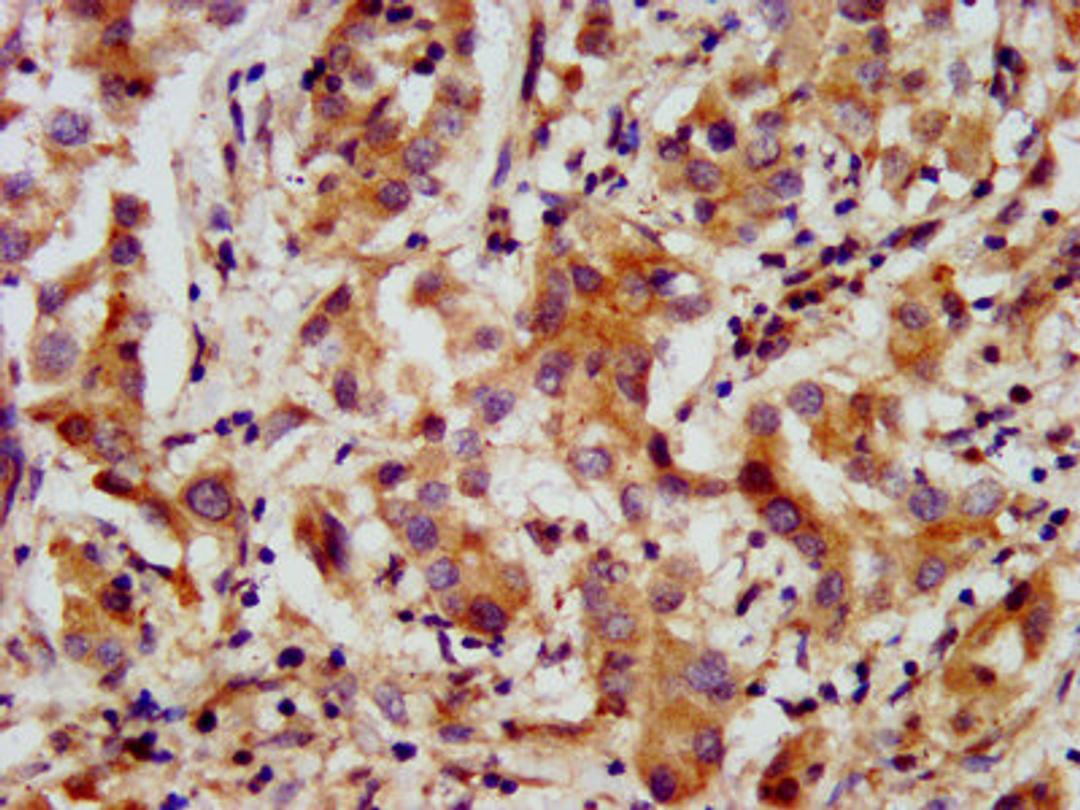 IHC image of CSB-PA22559A0Rb diluted at 1:200 and staining in paraffin-embedded human liver cancer performed on a Leica BondTM system. After dewaxing and hydration, antigen retrieval was mediated by high pressure in a citrate buffer (pH 6.0). Section was blocked with 10% normal goat serum 30min at RT. Then primary antibody (1% BSA) was incubated at 4&deg;C overnight. The primary is detected by a biotinylated secondary antibody and visualized using an HRP conjugated SP system.
