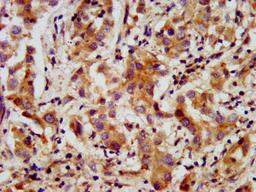 IHC image of CSB-PA22559A0Rb diluted at 1:200 and staining in paraffin-embedded human liver cancer performed on a Leica BondTM system. After dewaxing and hydration, antigen retrieval was mediated by high pressure in a citrate buffer (pH 6.0). Section was blocked with 10% normal goat serum 30min at RT. Then primary antibody (1% BSA) was incubated at 4&deg;C overnight. The primary is detected by a biotinylated secondary antibody and visualized using an HRP conjugated SP system.