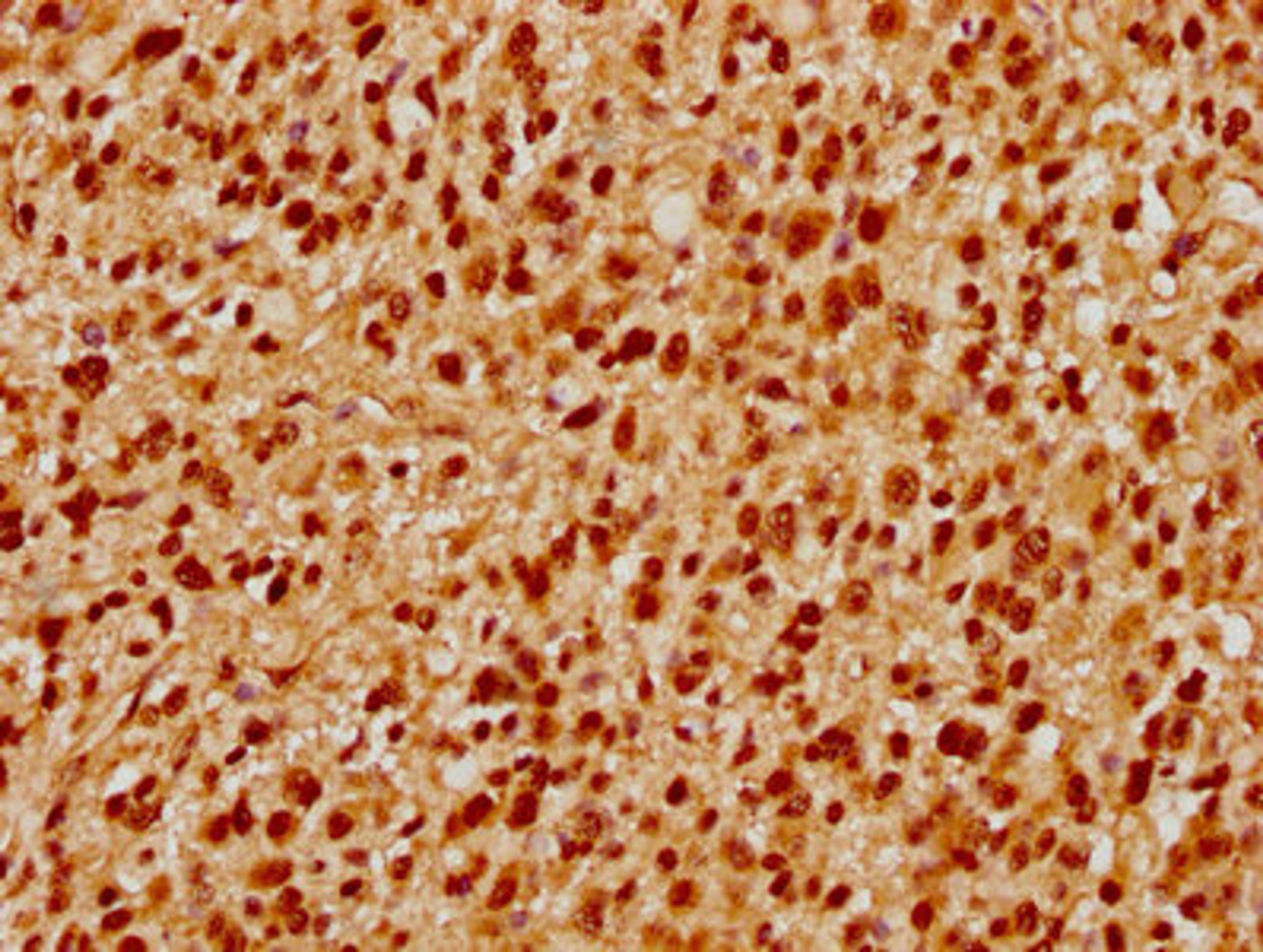 IHC image of CSB-PA769774LA01HU diluted at 1:500 and staining in paraffin-embedded human glioma performed on a Leica BondTM system. After dewaxing and hydration, antigen retrieval was mediated by high pressure in a citrate buffer (pH 6.0). Section was blocked with 10% normal goat serum 30min at RT. Then primary antibody (1% BSA) was incubated at 4°C overnight. The primary is detected by a biotinylated secondary antibody and visualized using an HRP conjugated SP system.