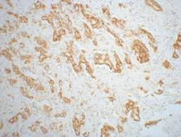 IHC staining of mouse prostate adenocarcinoma tissue, diluted at 1:200.