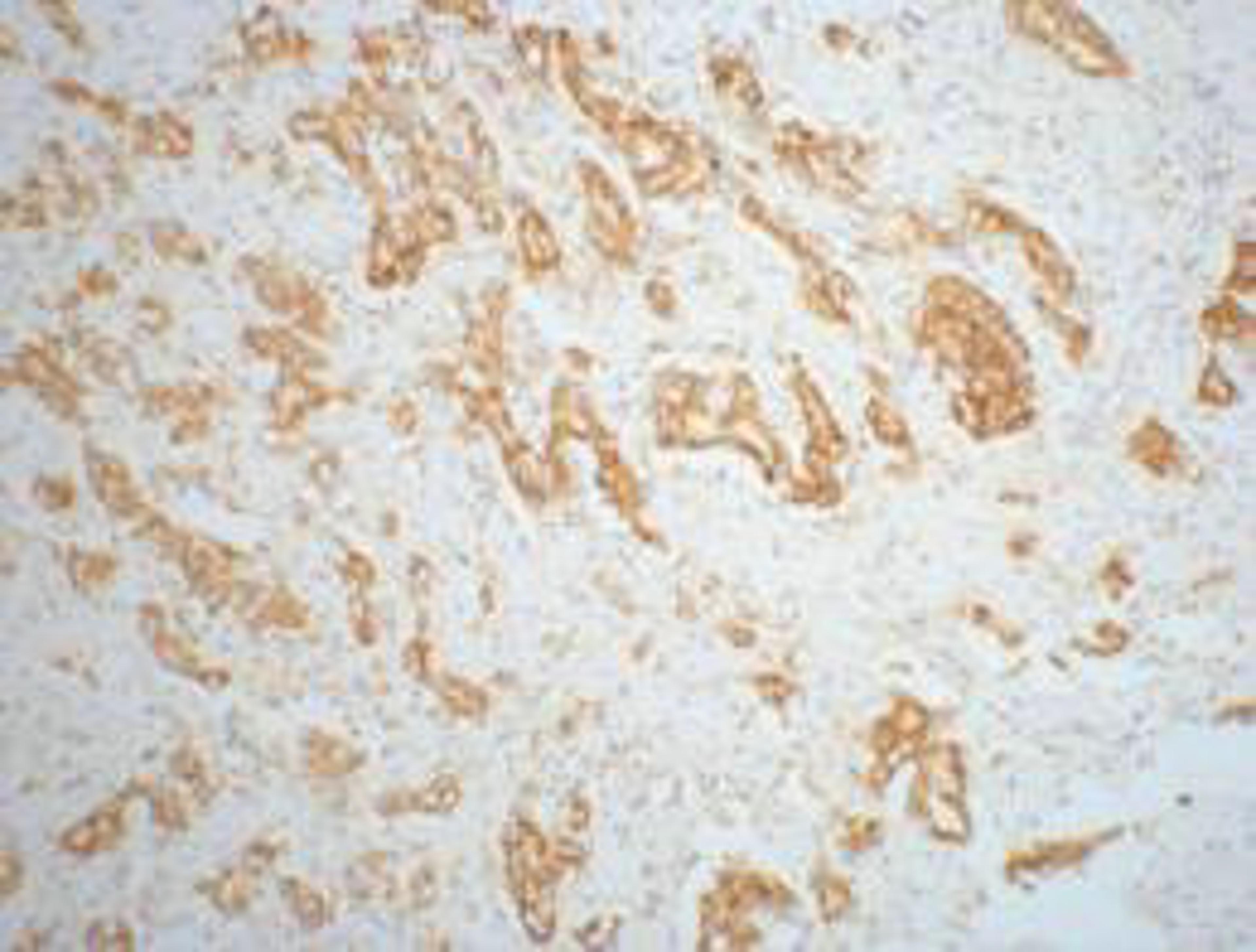 IHC staining of mouse prostate adenocarcinoma tissue, diluted at 1:200.