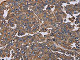 The image on the left is immunohistochemistry of paraffin-embedded Human ovarian cancer tissue using CSB-PA438776(KRT31 Antibody) at dilution 1/20, on the right is treated with fusion protein. (Original magnification: ×200)