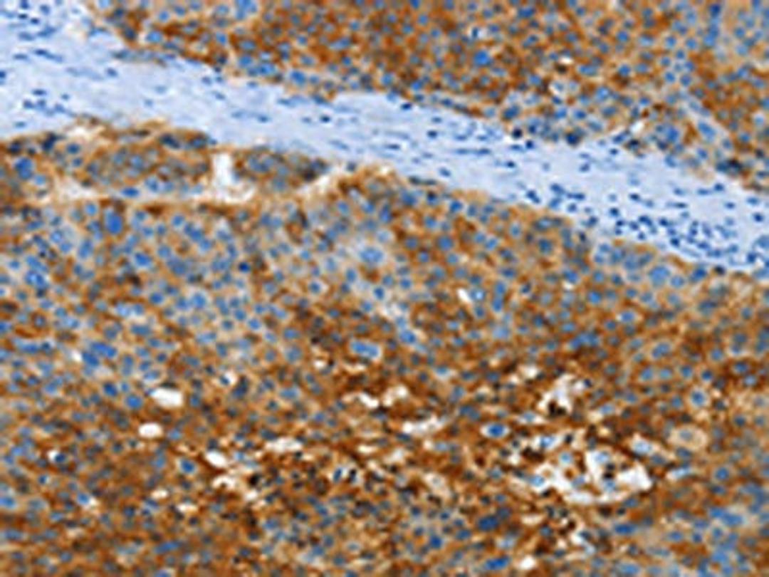 The image on the left is immunohistochemistry of paraffin-embedded Human liver cancer tissue using CSB-PA151772(ANXA13 Antibody) at dilution 1/40, on the right is treated with fusion protein. (Original magnification: ×200)