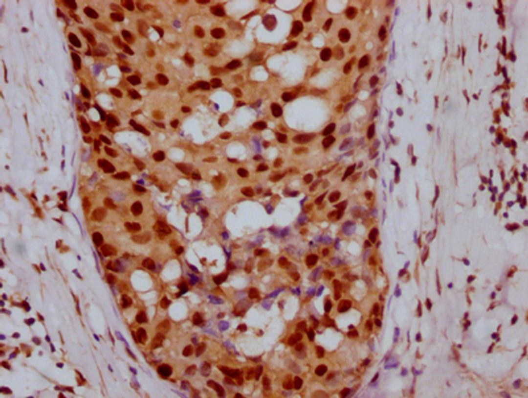 IHC image of CSB-RA968740A0HU diluted at 1:100 and staining in paraffin-embedded human breast cancer performed on a Leica BondTM system. After dewaxing and hydration, antigen retrieval was mediated by high pressure in a citrate buffer (pH 6.0). Section was blocked with 10% normal goat serum 30min at RT. Then primary antibody (1% BSA) was incubated at 4℃ overnight. The primary is detected by a Goat anti-rabbit IgG polymer labeled by HRP and visualized using 0.05% DAB.