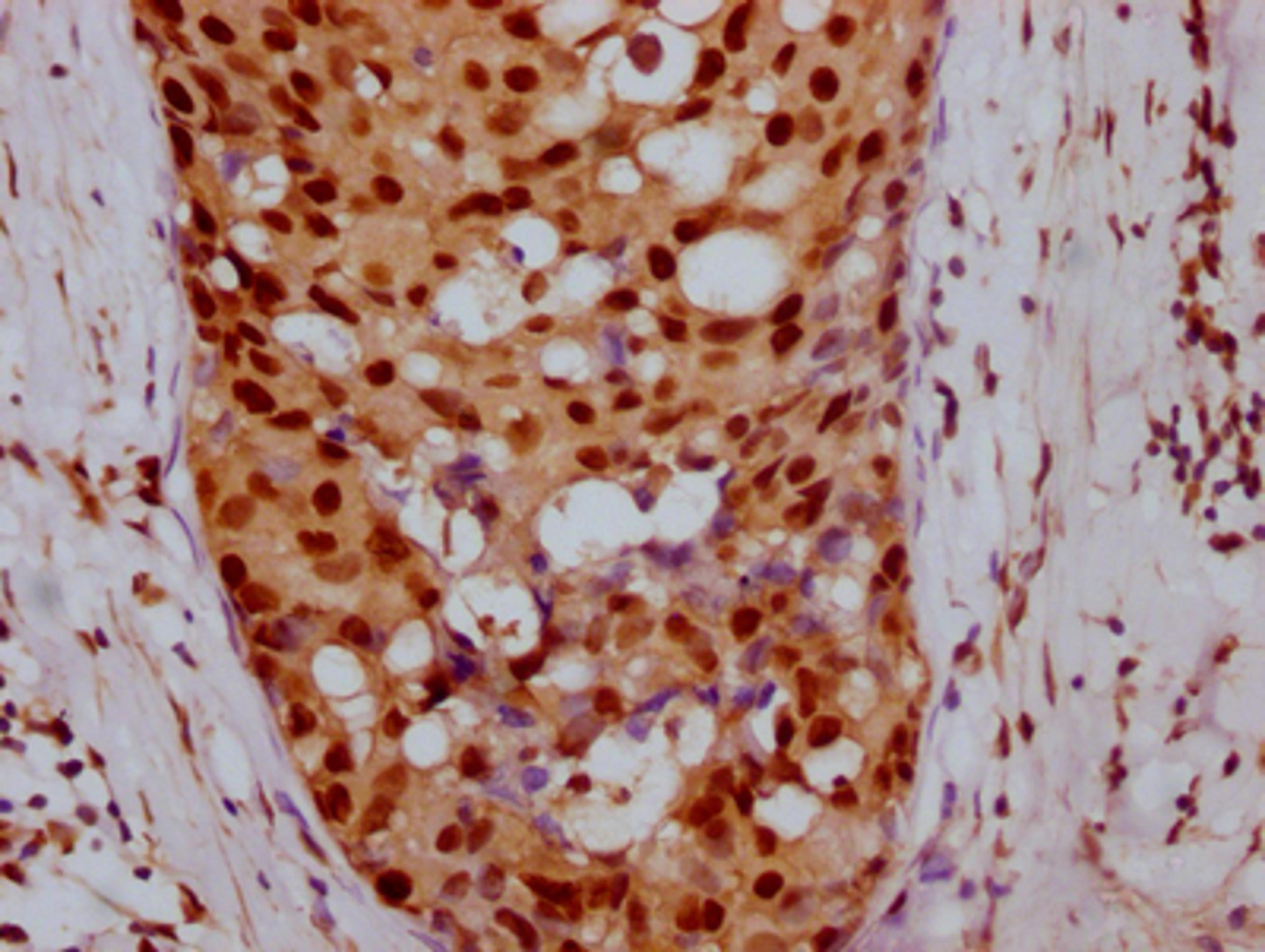 IHC image of CSB-RA968740A0HU diluted at 1:100 and staining in paraffin-embedded human breast cancer performed on a Leica BondTM system. After dewaxing and hydration, antigen retrieval was mediated by high pressure in a citrate buffer (pH 6.0). Section was blocked with 10% normal goat serum 30min at RT. Then primary antibody (1% BSA) was incubated at 4℃ overnight. The primary is detected by a Goat anti-rabbit IgG polymer labeled by HRP and visualized using 0.05% DAB.
