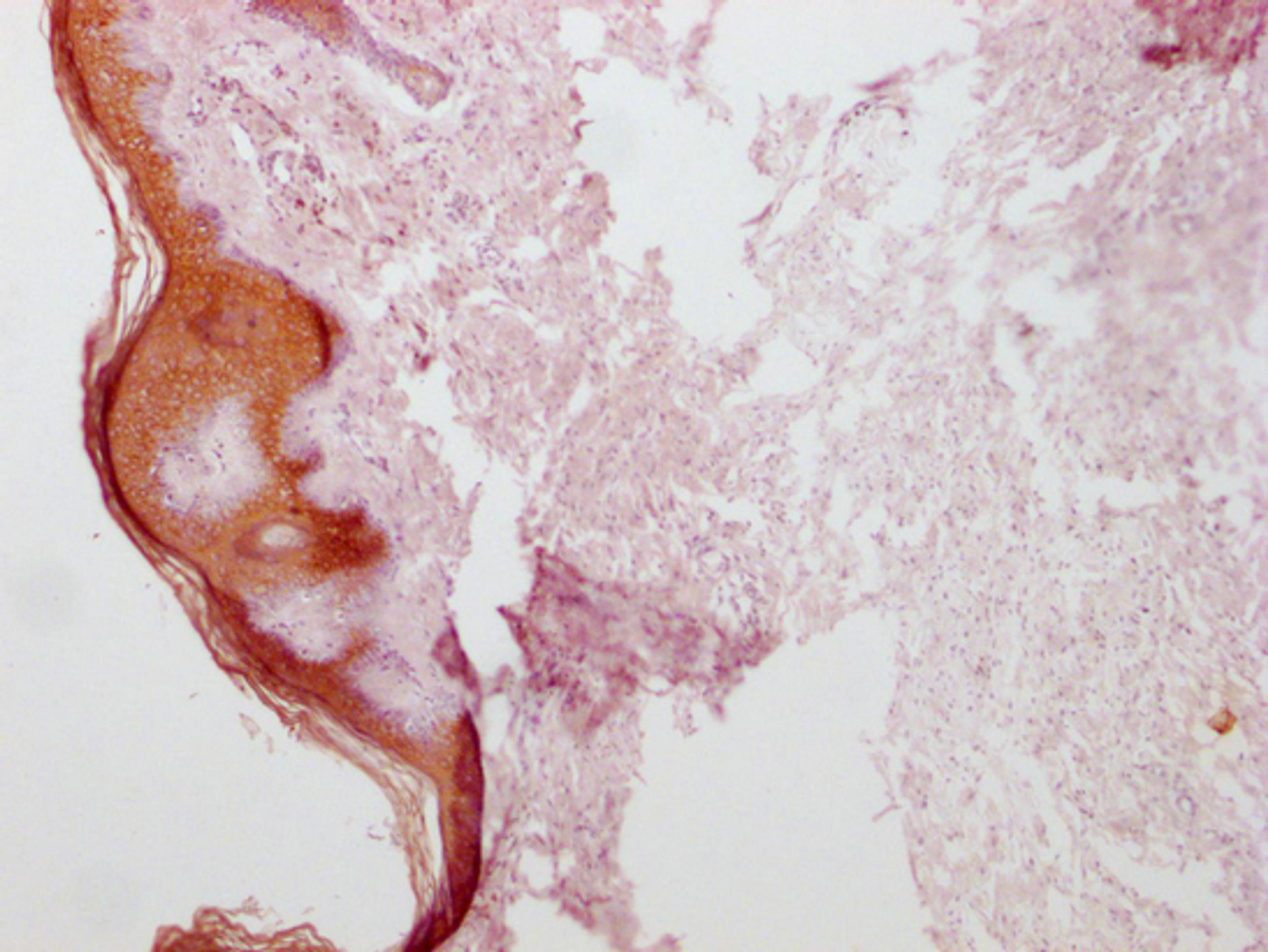 IHC image of CSB-MA555839 diluted at 1:100 and staining in paraffin-embedded human skin tissue performed on a Leica BondTM system. After dewaxing and hydration, antigen retrieval was mediated by high pressure in a citrate buffer (pH 6.0). Section was blocked with 10% normal goat serum 30min at RT. Then primary antibody (1% BSA) was incubated at 4°C overnight. The primary is detected by a Goat anti-mouse IgG polymer labeled by HRP and visualized using 0.05% DAB.