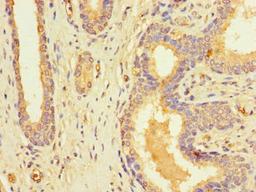 Immunohistochemistry of paraffin-embedded human prostate cancer using CSB-PA836167LA01HU at dilution of 1:100