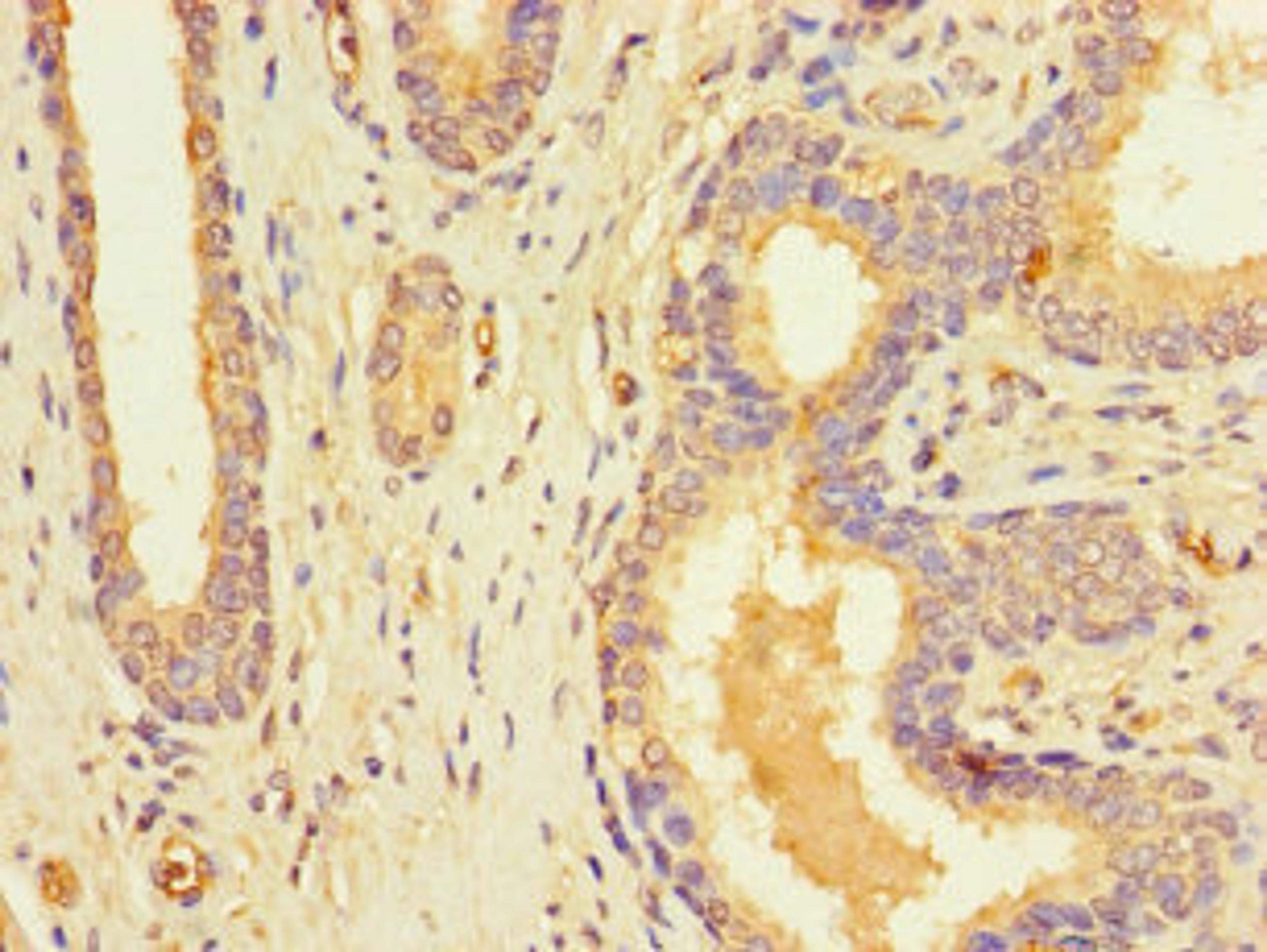 Immunohistochemistry of paraffin-embedded human prostate cancer using CSB-PA836167LA01HU at dilution of 1:100
