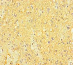 Immunohistochemistry of paraffin-embedded human glioma using CSB-PA892496LA01HU at dilution of 1:100