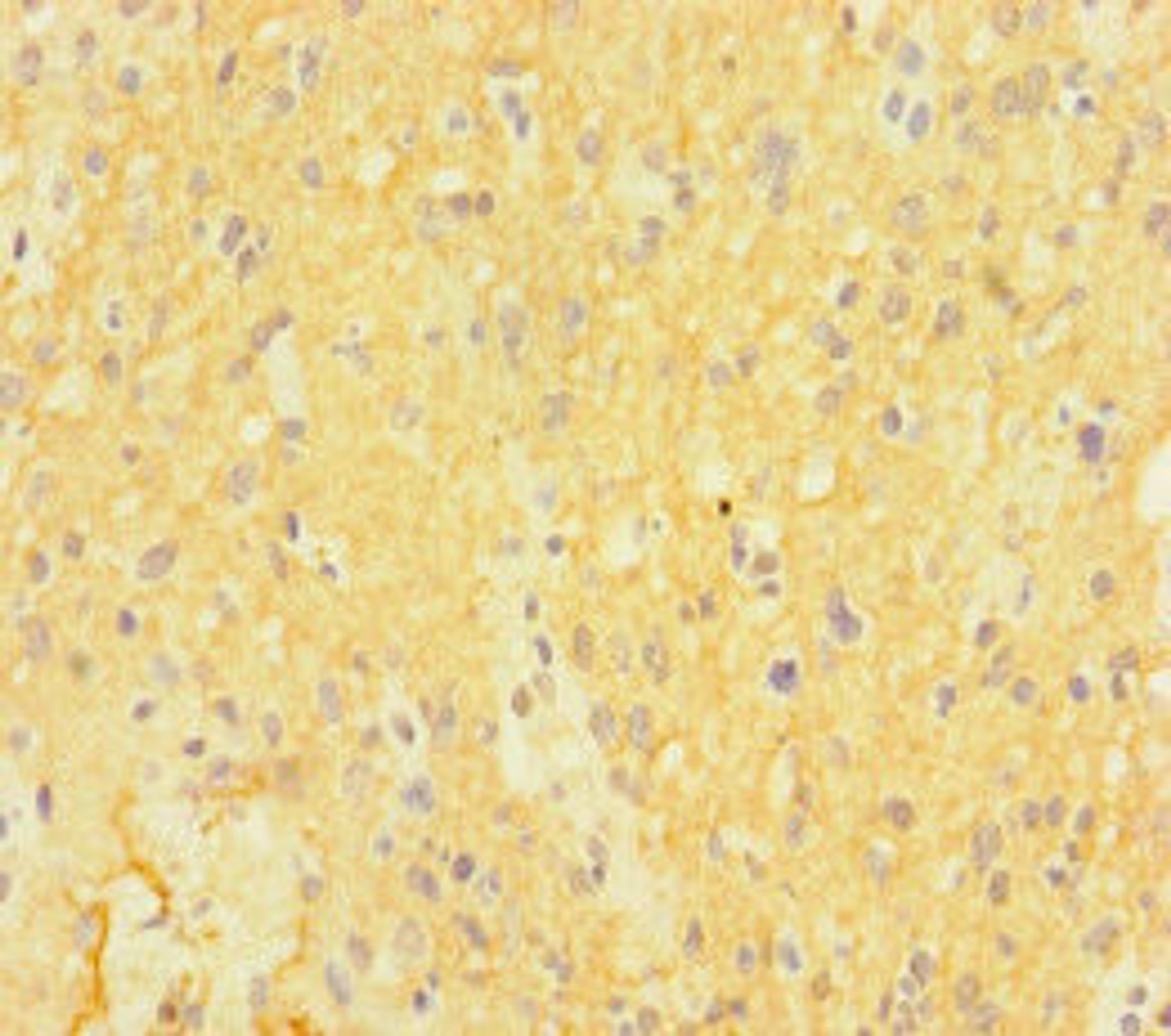 Immunohistochemistry of paraffin-embedded human glioma using CSB-PA892496LA01HU at dilution of 1:100