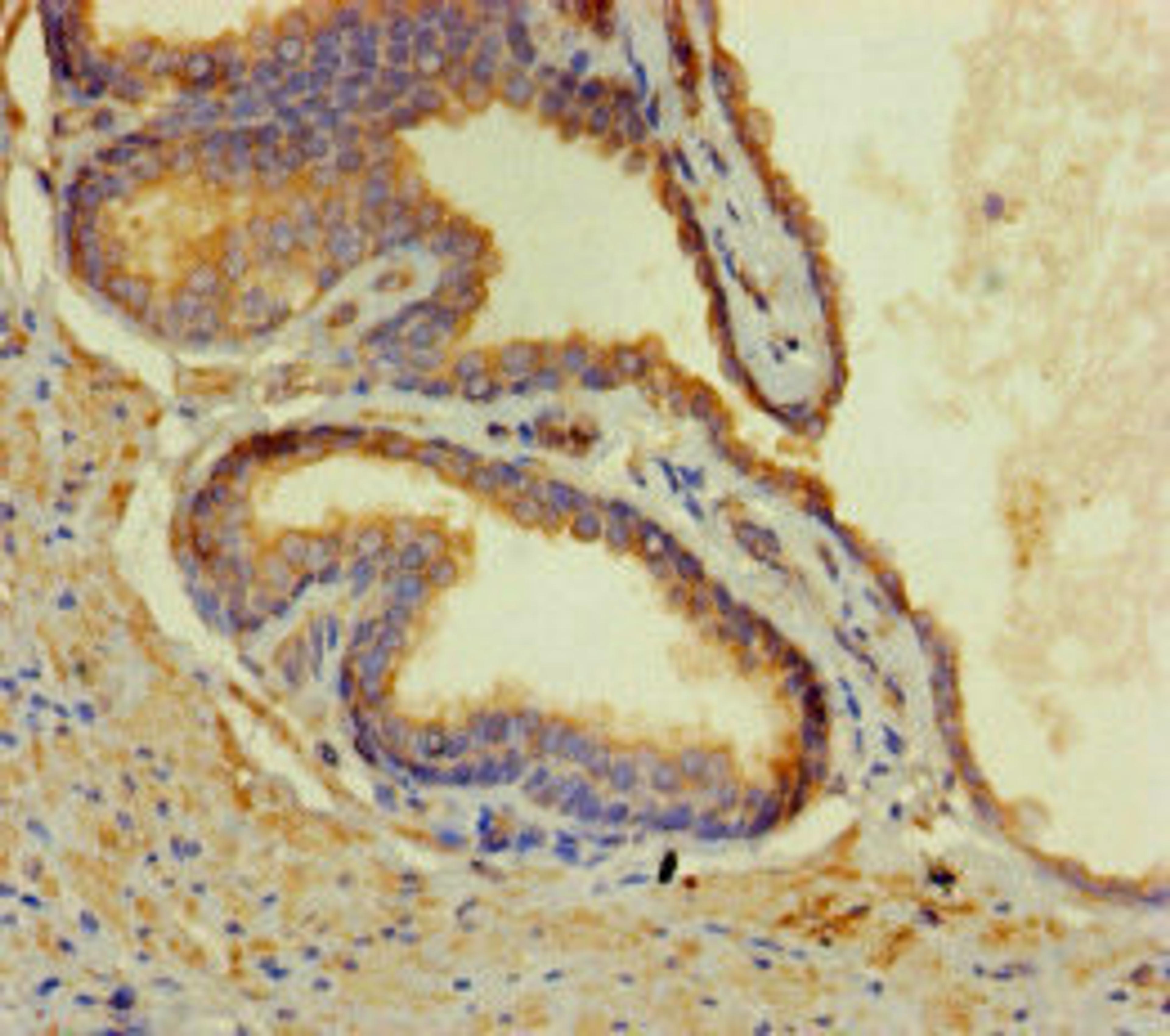 Immunohistochemistry of paraffin-embedded human prostate cancer using CSB-PA880087LA01HU at dilution of 1:100