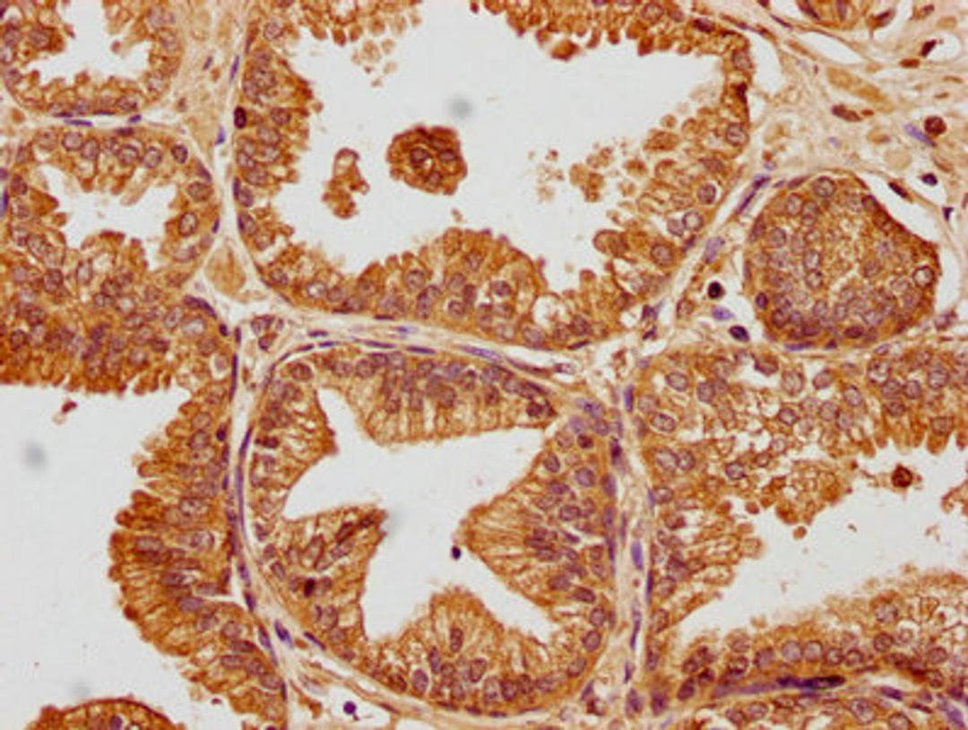 IHC image of CSB-PA009018PA01HU diluted at 1:100 and staining in paraffin-embedded human prostate cancer performed on a Leica BondTM system. After dewaxing and hydration, antigen retrieval was mediated by high pressure in a citrate buffer (pH 6.0). Section was blocked with 10% normal goat serum 30min at RT. Then primary antibody (1% BSA) was incubated at 4°C overnight. The primary is detected by a biotinylated secondary antibody and visualized using an HRP conjugated SP system.