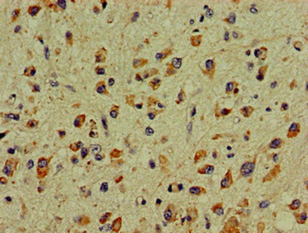 Immunohistochemistry of paraffin-embedded human glioma using CSB-PA006548LA01HU at dilution of 1:100