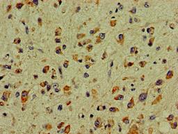 Immunohistochemistry of paraffin-embedded human glioma using CSB-PA006548LA01HU at dilution of 1:100