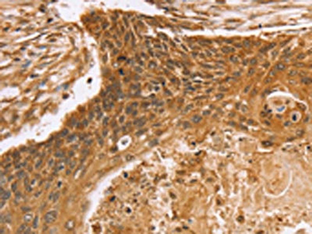 The image on the left is immunohistochemistry of paraffin-embedded Human esophagus cancer tissue using CSB-PA200577(VIM Antibody) at dilution 1/20, on the right is treated with fusion protein. (Original magnification: ×200)